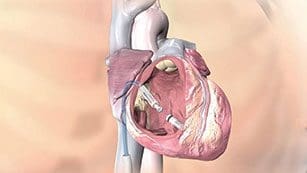 TPS cardiac device inside heart